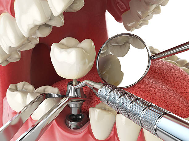 Best Emergency Dental Care for Broken or Chipped Teeth in Livingston, MT